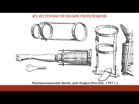 ИЗ ИСТОРИИ ЛЕЧЕНИЯ ПЕРЕЛОМОВ