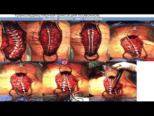 транспедикулярная фиксация позвонков;