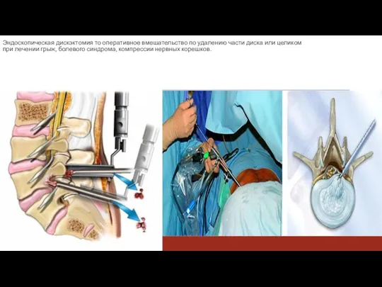 Эндоскопическая дискэктомия то оперативное вмешательство по удалению части диска или целиком