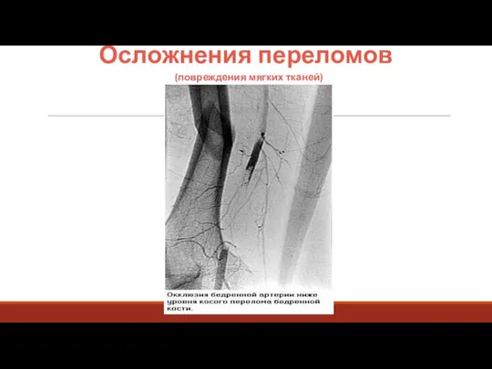 Осложнения переломов (повреждения мягких тканей)