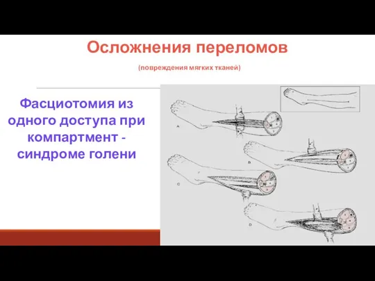 Осложнения переломов (повреждения мягких тканей) Фасциотомия из одного доступа при компартмент - синдроме голени