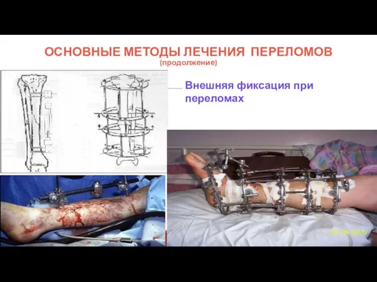 ОСНОВНЫЕ МЕТОДЫ ЛЕЧЕНИЯ ПЕРЕЛОМОВ (продолжение) Внешняя фиксация при переломах