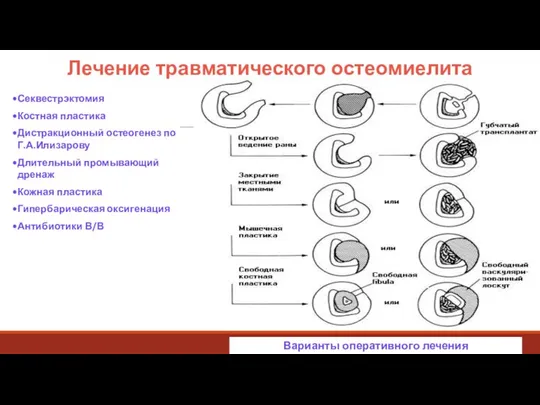 Лечение травматического остеомиелита Секвестрэктомия Костная пластика Дистракционный остеогенез по Г.А.Илизарову Длительный