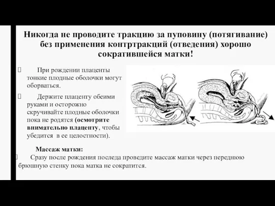 Никогда не проводите тракцию за пуповину (потягивание) без применения контртракций (отведения)