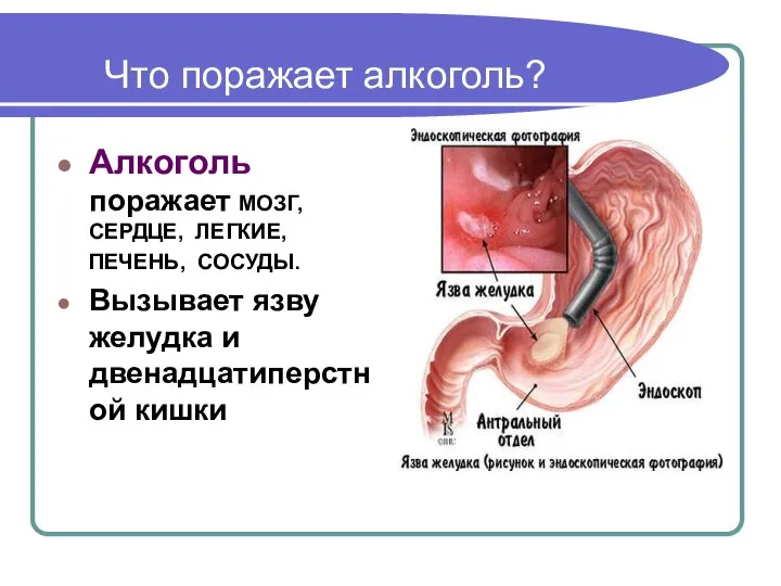 Что поражает алкоголь? Алкоголь поражает МОЗГ, СЕРДЦЕ, ЛЕГКИЕ, ПЕЧЕНЬ, СОСУДЫ. Вызывает язву желудка и двенадцатиперстной кишки