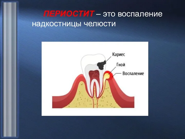 ПЕРИОСТИТ – это воспаление надкостницы челюсти