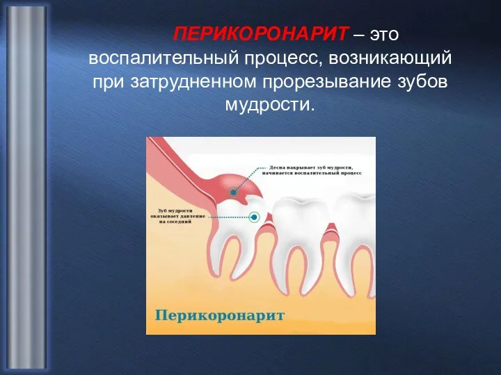 ПЕРИКОРОНАРИТ – это воспалительный процесс, возникающий при затрудненном прорезывание зубов мудрости.