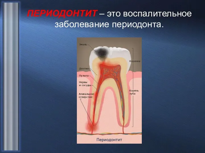 ПЕРИОДОНТИТ – это воспалительное заболевание периодонта.