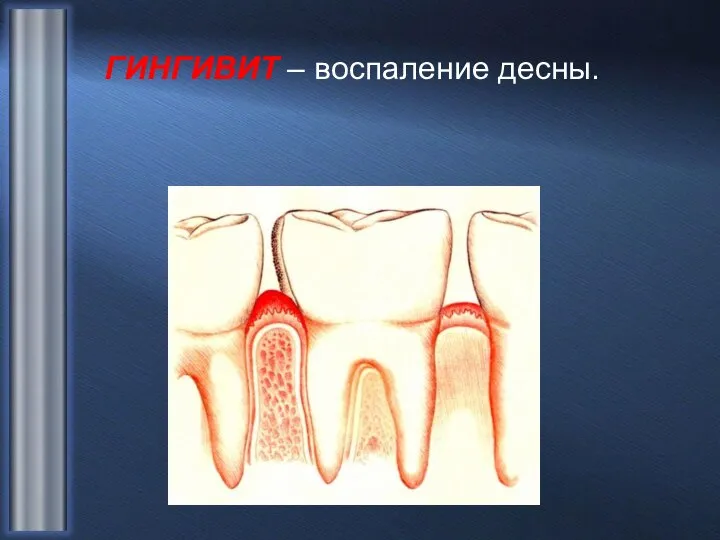 ГИНГИВИТ – воспаление десны.