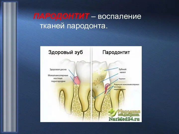 ПАРОДОНТИТ – воспаление тканей пародонта.