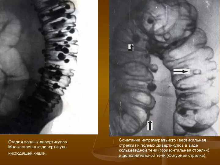 Стадия полных дивертикулов. Множественные дивертикулы нисходящей кишки. Сочетание интрамурального (вертикальная стрелка)