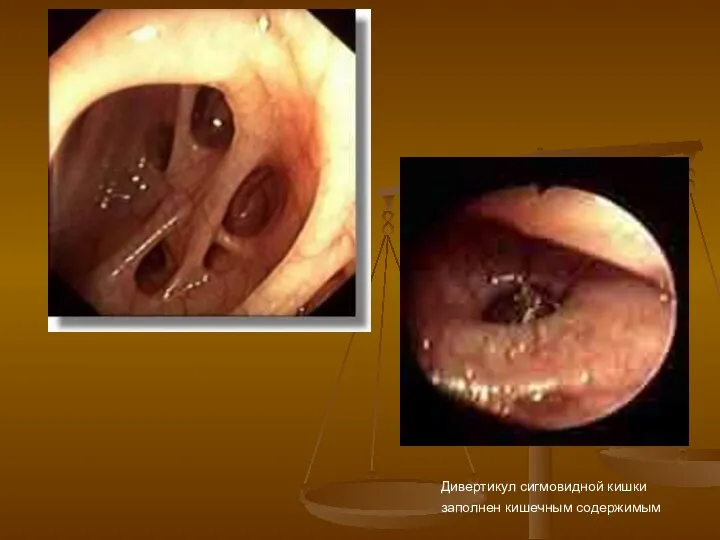 Дивертикул сигмовидной кишки заполнен кишечным содержимым