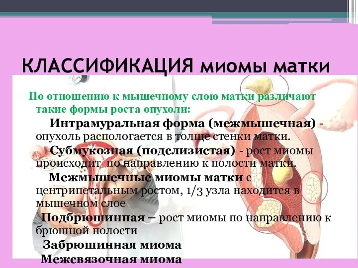 КЛАССИФИКАЦИЯ миомы матки По отношению к мышечному слою матки различают такие