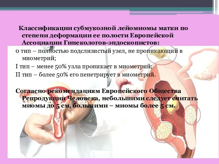 Классификации субмукозной лейомиомы матки по степени деформации ее полости Европейской Ассоциации