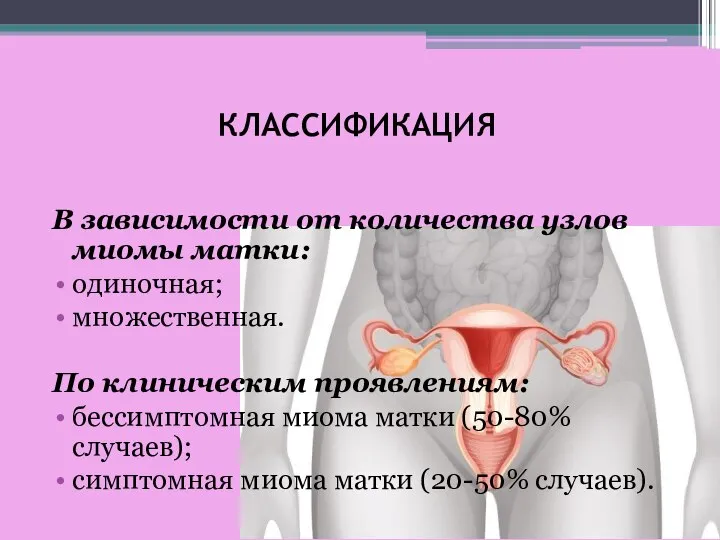 КЛАССИФИКАЦИЯ В зависимости от количества узлов миомы матки: одиночная; множественная. По