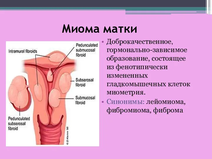 Миома матки Доброкачественное, гормонально-зависимое образование, состоящее из фенотипически измененных гладкомышечных клеток миометрия. Синонимы: лейомиома, фибромиома, фиброма