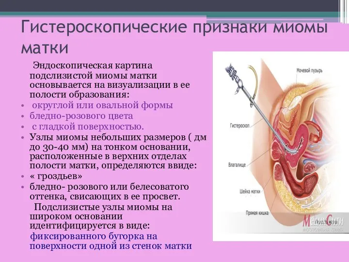 Гистероскопические признаки миомы матки Эндоскопическая картина подслизистой миомы матки основывается на