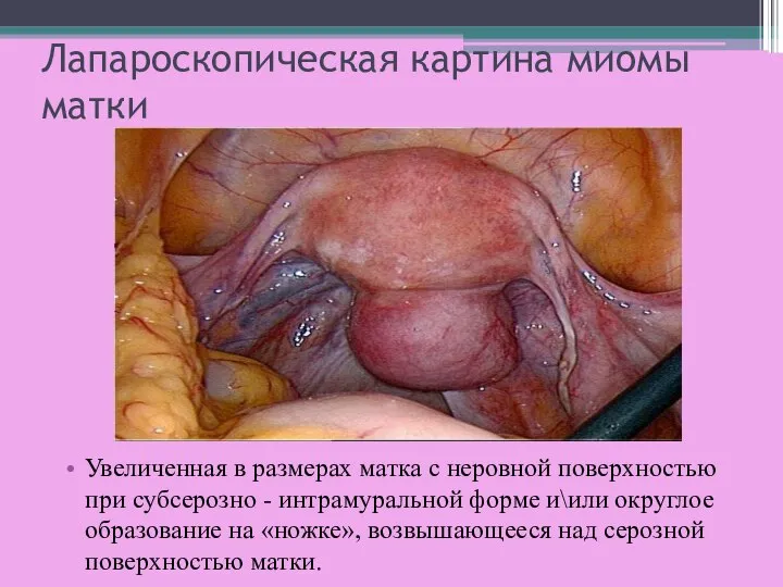 Лапароскопическая картина миомы матки Увеличенная в размерах матка с неровной поверхностью