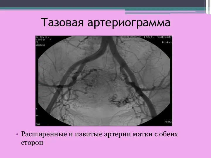 Тазовая артериограмма Расширенные и извитые артерии матки с обеих сторон