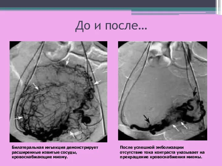 До и после… Билатеральная инъекция демонстрирует расширенные извитые сосуды, кровоснабжающие миому.