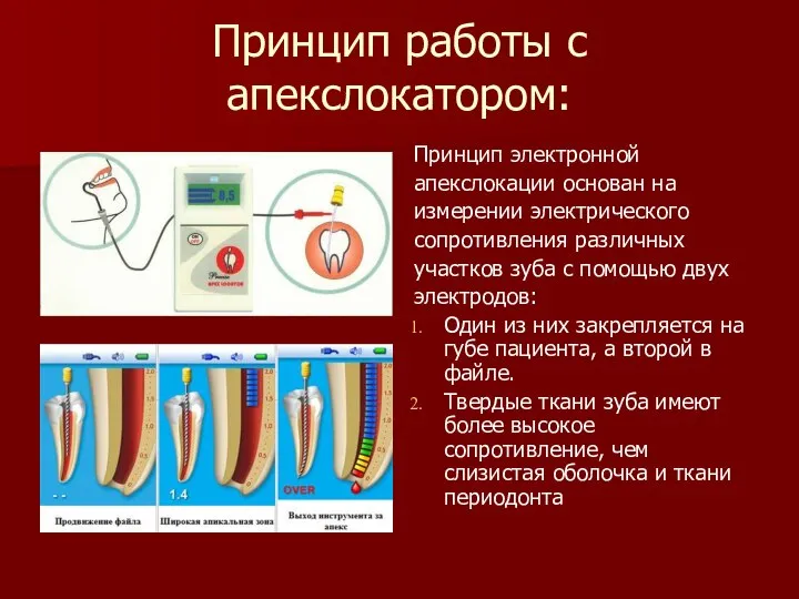 Принцип работы с апекслокатором: Принцип электронной апекслокации основан на измерении электрического