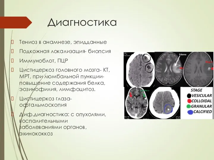 Диагностика Тениоз в анамнезе, эпидданные Подкожная локализация- биопсия Иммуноблот, ПЦР Цистицеркоз