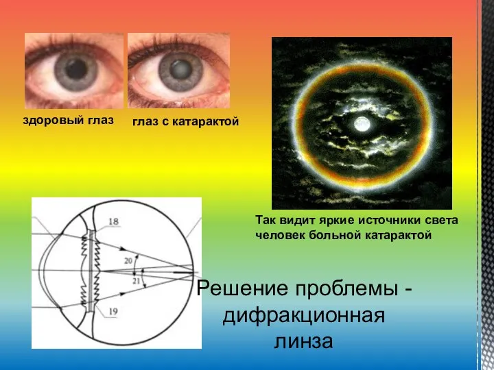 здоровый глаз глаз с катарактой Так видит яркие источники света человек