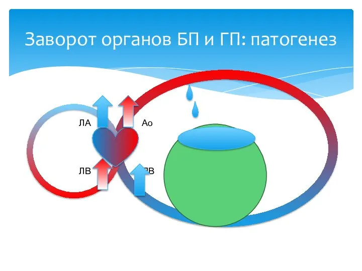 Ао ПВ ЛА ЛВ Заворот органов БП и ГП: патогенез