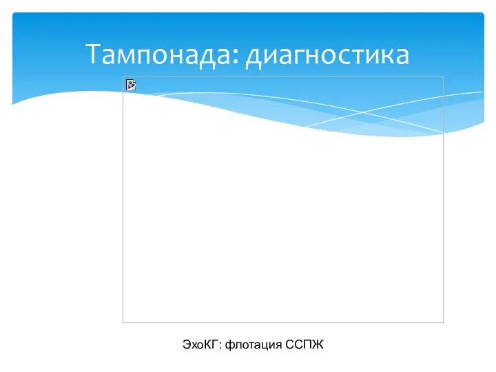 Тампонада: диагностика ЭхоКГ: флотация ССПЖ