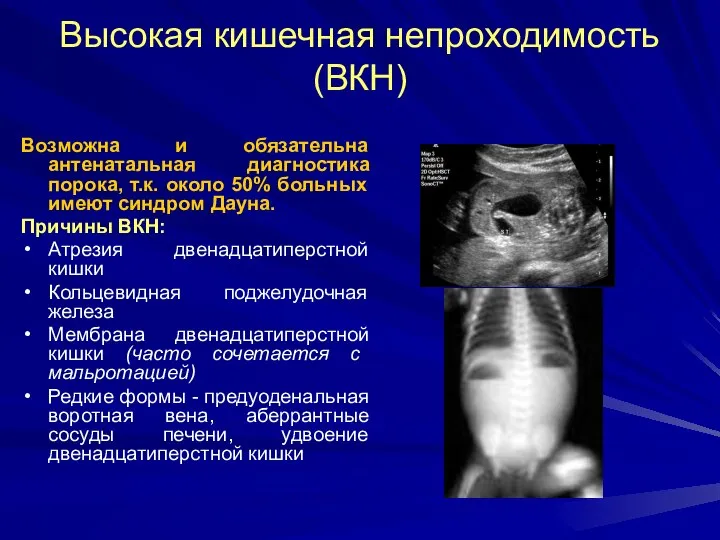 Высокая кишечная непроходимость (ВКН) Возможна и обязательна антенатальная диагностика порока, т.к.