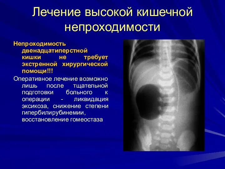 Лечение высокой кишечной непроходимости Непроходимость двенадцатиперстной кишки не требует экстренной хирургической