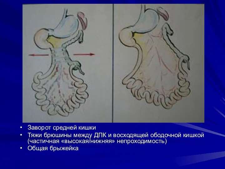 Заворот средней кишки Тяжи брюшины между ДПК и восходящей ободочной кишкой (частичная «высокая/нижняя» непроходимость) Общая брыжейка