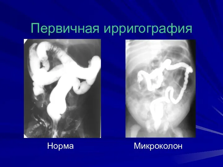 Первичная ирригография Норма Микроколон