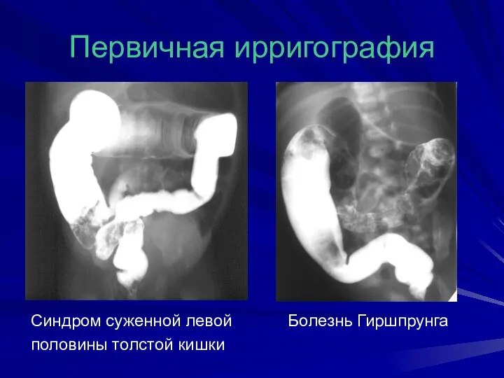 Первичная ирригография Синдром суженной левой Болезнь Гиршпрунга половины толстой кишки