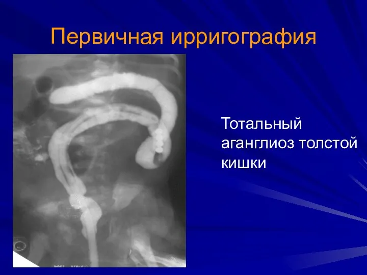 Первичная ирригография Тотальный аганглиоз толстой кишки