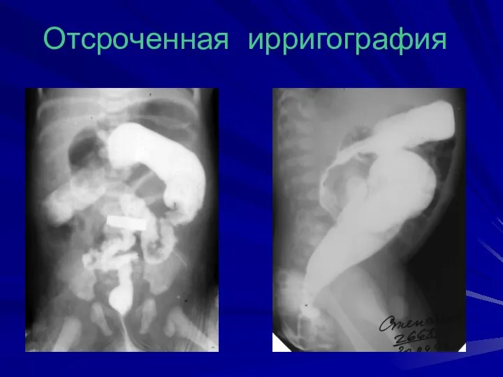 Отсроченная ирригография