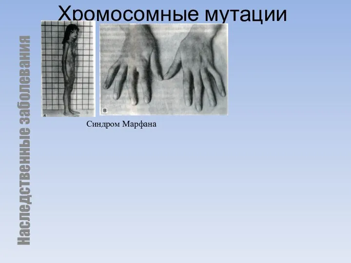 Хромосомные мутации Наследственные заболевания Синдром Марфана