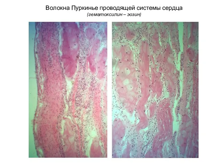 Волокна Пуркинье проводящей системы сердца (гематоксилин – эозин)
