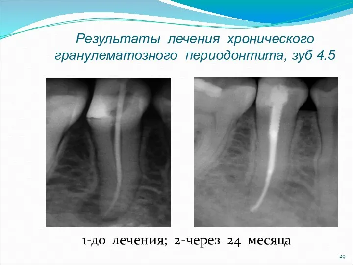 Результаты лечения хронического гранулематозного периодонтита, зуб 4.5 1-до лечения; 2-через 24 месяца