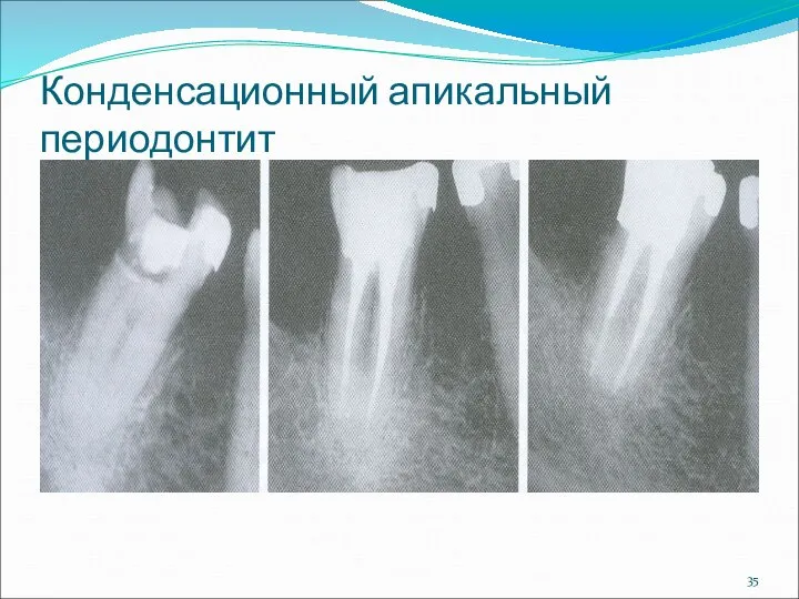 Конденсационный апикальный периодонтит