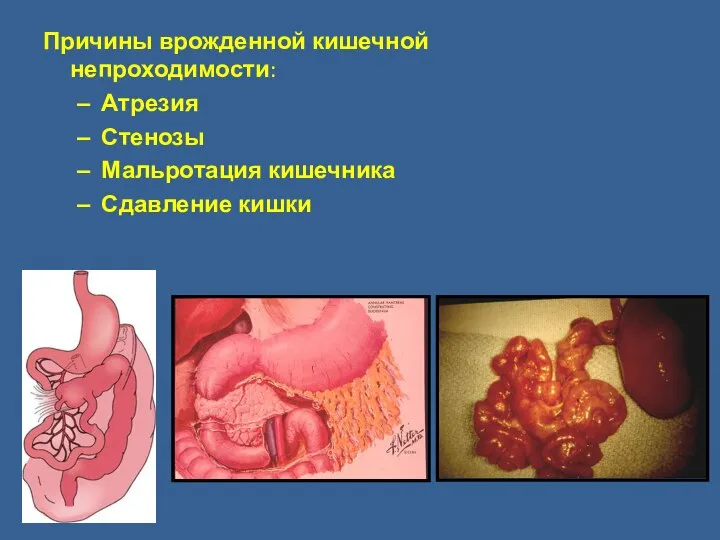 Причины врожденной кишечной непроходимости: Атрезия Стенозы Мальротация кишечника Сдавление кишки