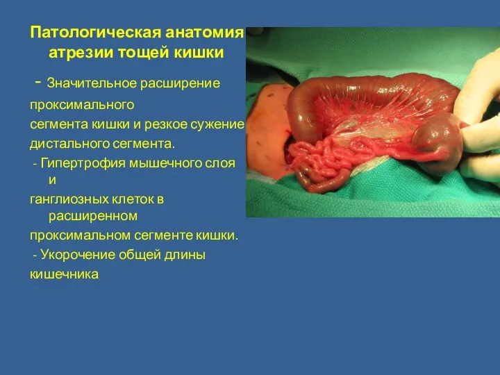 Патологическая анатомия атрезии тощей кишки - Значительное расширение проксимального сегмента кишки