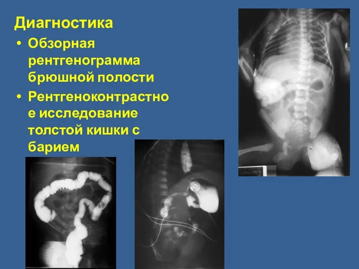 Диагностика Обзорная рентгенограмма брюшной полости Рентгеноконтрастное исследование толстой кишки с барием