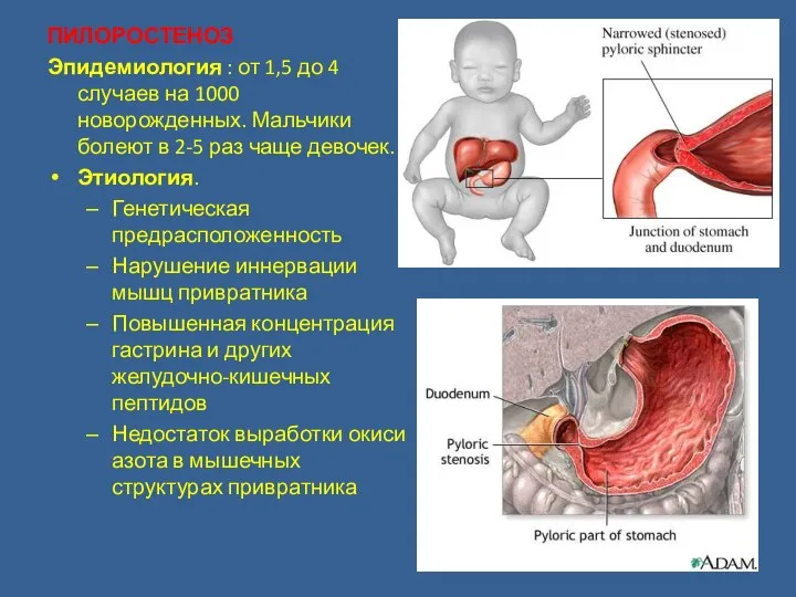 ПИЛОРОСТЕНОЗ Эпидемиология : от 1,5 до 4 случаев на 1000 новорожденных.