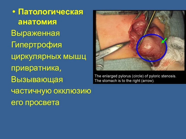 Патологическая анатомия Выраженная Гипертрофия циркулярных мышц привратника, Вызывающая частичную окклюзию его просвета