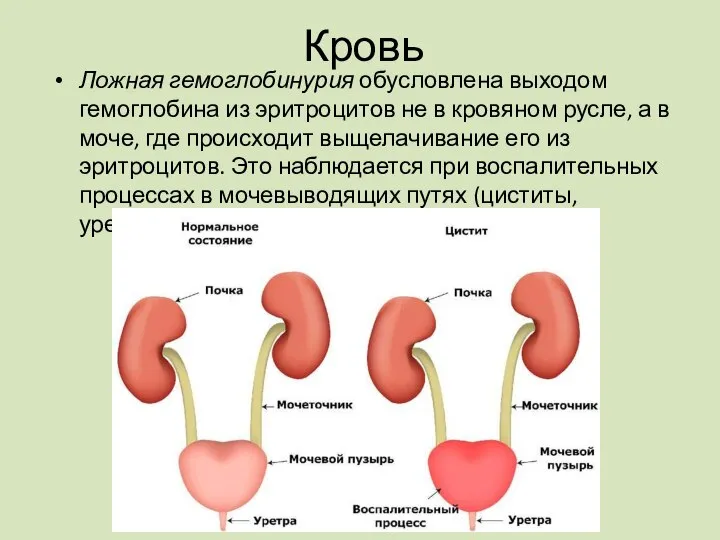 Ложная гемоглобинурия обусловлена выходом гемоглобина из эритроцитов не в кровяном русле,