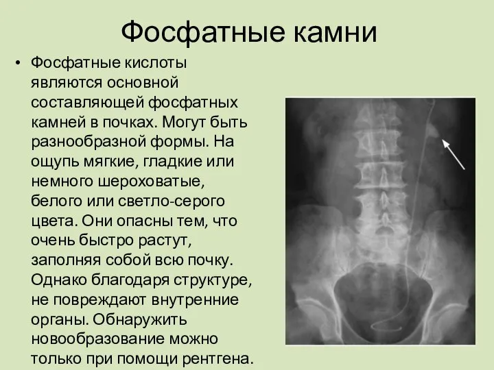 Фосфатные камни Фосфатные кислоты являются основной составляющей фосфатных камней в почках.