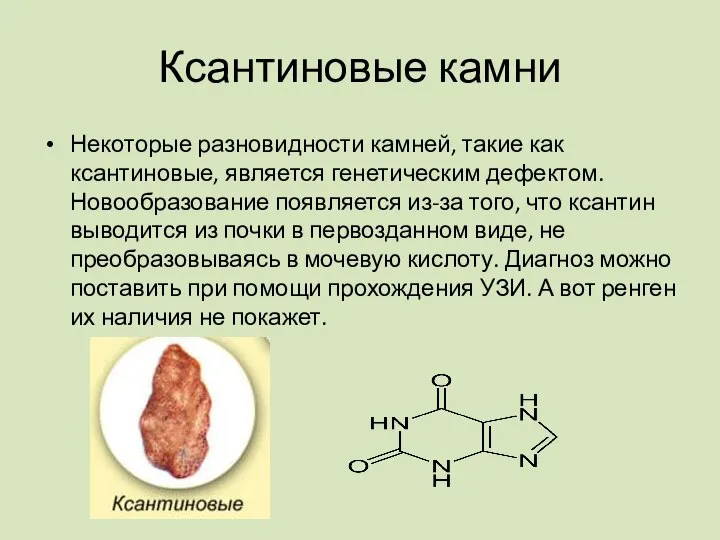 Ксантиновые камни Некоторые разновидности камней, такие как ксантиновые, является генетическим дефектом.