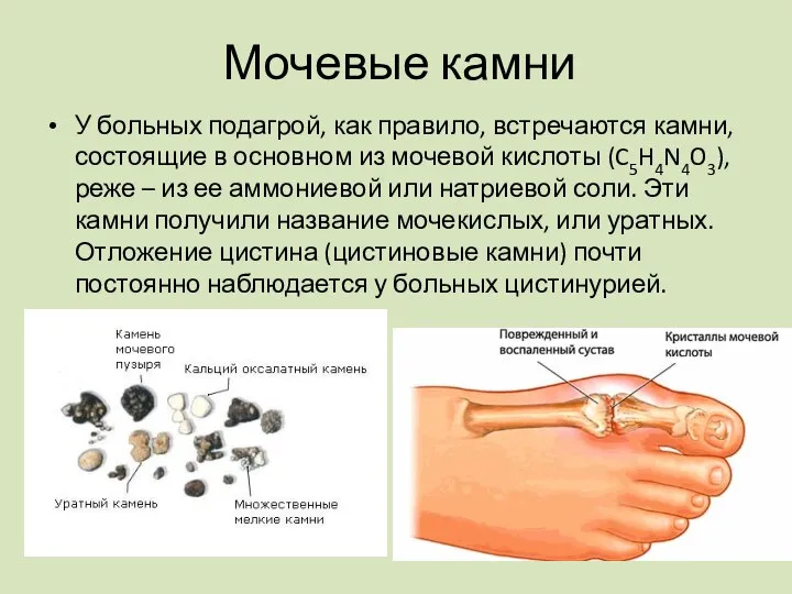 У больных подагрой, как правило, встречаются камни, состоящие в основном из