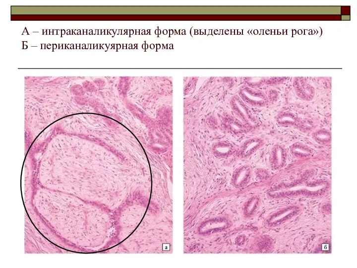 А – интраканаликулярная форма (выделены «оленьи рога») Б – периканаликуярная форма